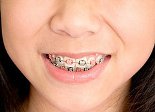 braces-teeth