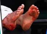 blood-feet-boston