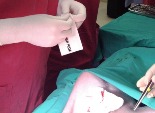 bioweld1-surgery-stitches
